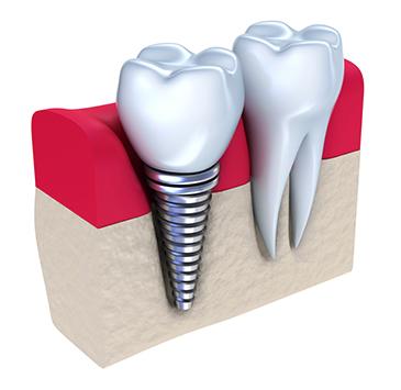 Dental Implants in O'Fallon, IL