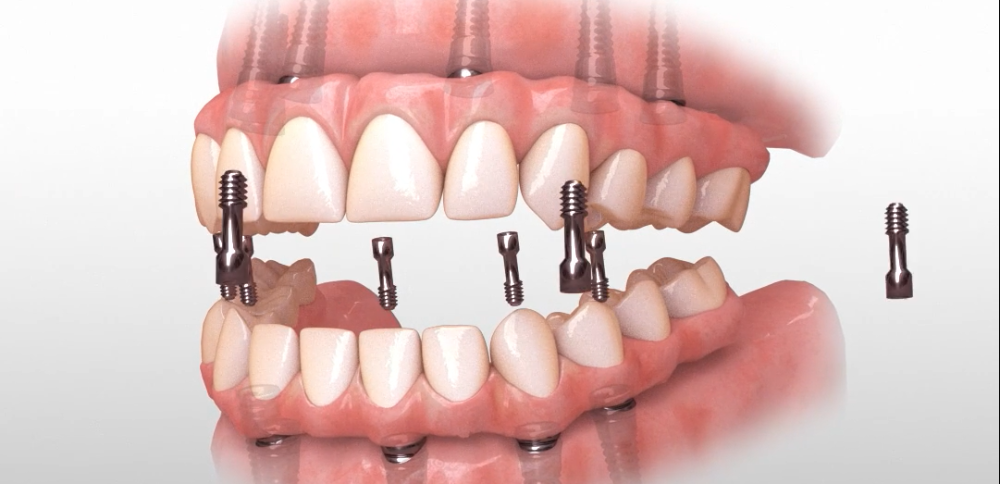 Hybridge Dental Implants in O'Fallon, IL